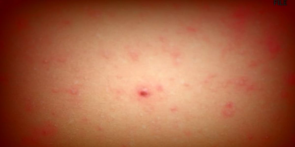 Measles Case Confirmed in South Carolina: What You Need to Know