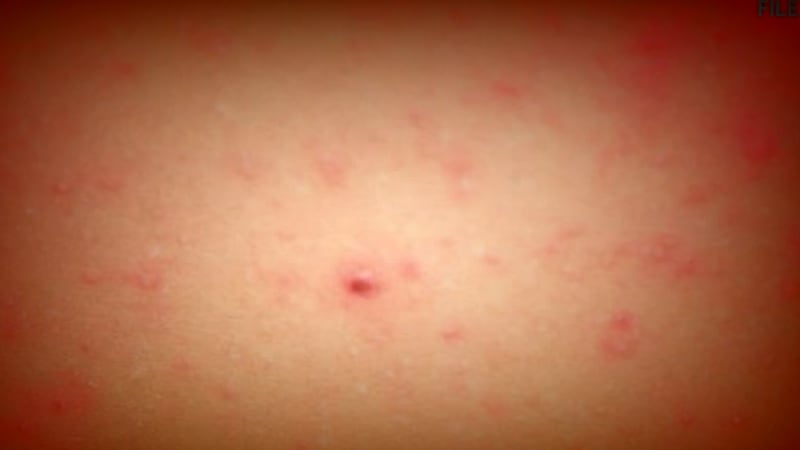 Measles is a serious disease that can lead to hospitalization and even death. The initial...