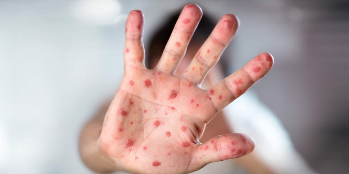 SC health department reports 3rd case of measles in state this year SC health department reports 3rd case of measles in state this year