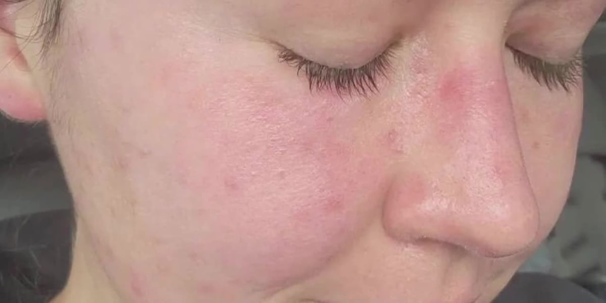 Woman says West Nile virus gave her severe migraines, dizziness and partial hearing loss